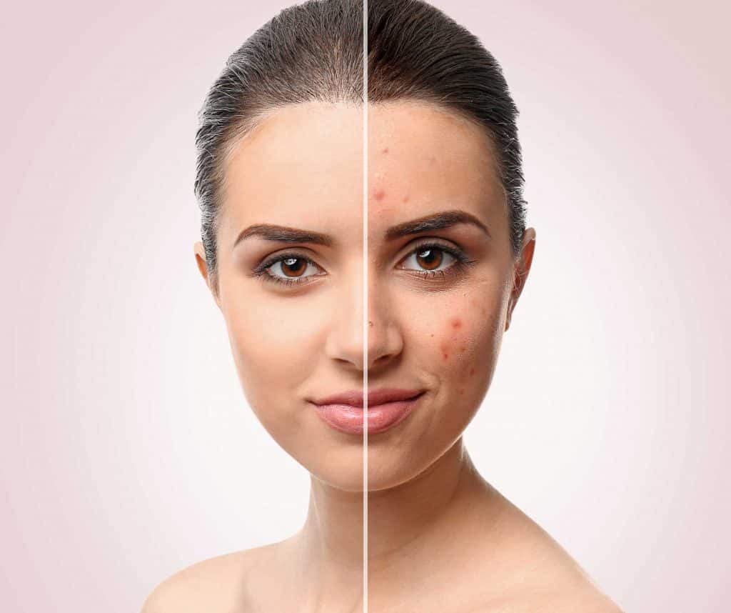 Before and after acne treatment Edmonton