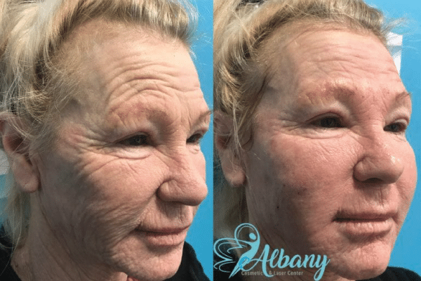 Sculptra Treatment PRP Results