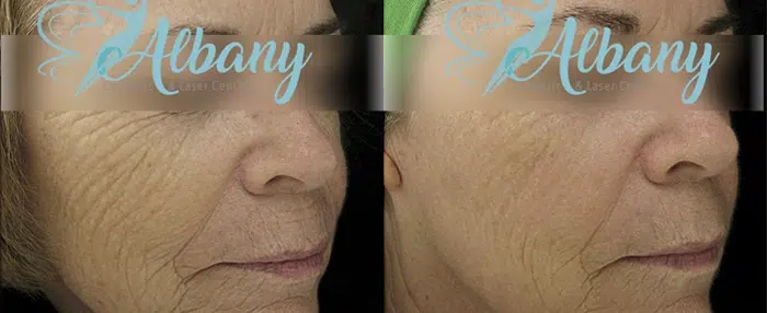 Skin tightening