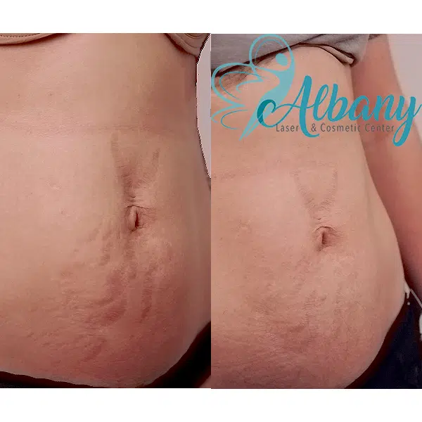 Removal of stretch marks