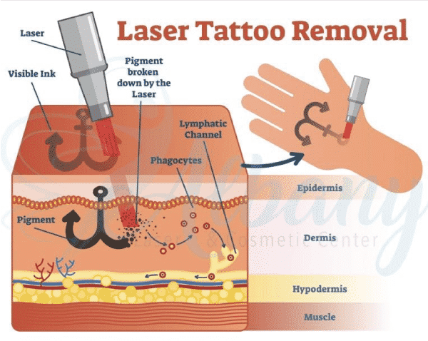 Benefits Of Laser Tattoo Removal by Caddells Laser  Electrolysis Clinic   Issuu