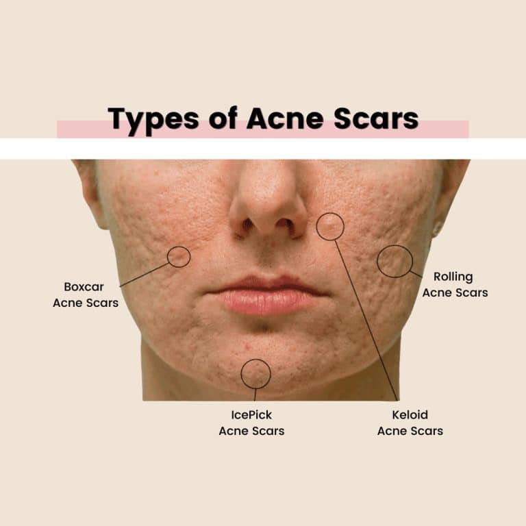 Acne scars types