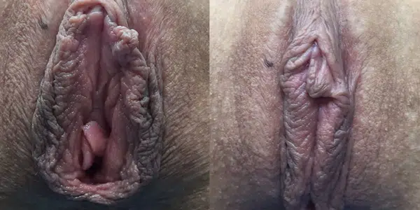 Before vaginal whitening
