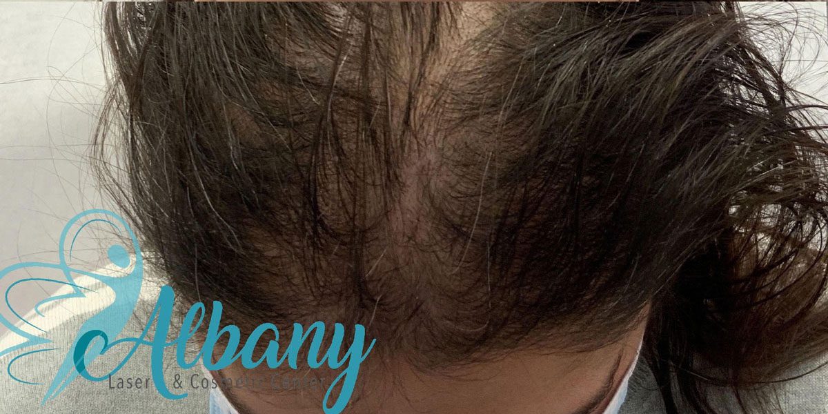 After prp hair loss