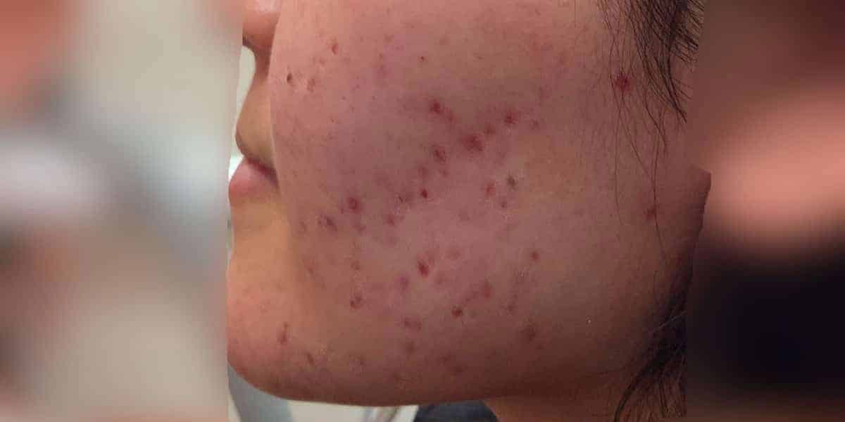 Before-acne-scar-treatment-case-1074-2