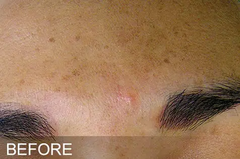 before hydrafacial for acne pigmentation