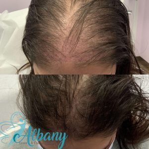hair loss results