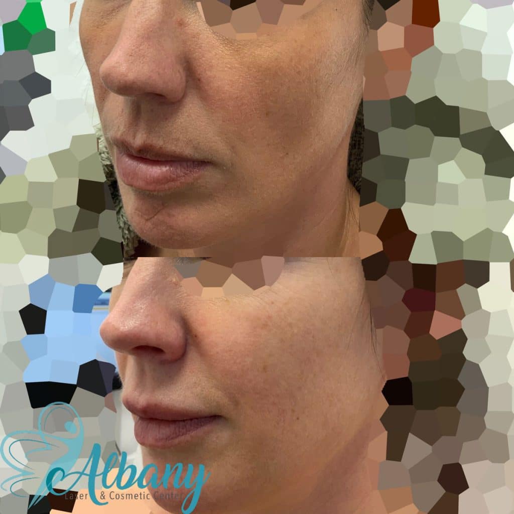 sculptra facial rejuvenation