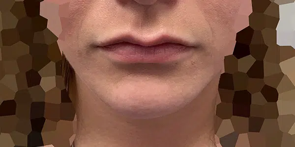 Before lip fillers