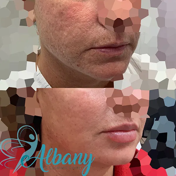 Fractional laser for acne scars