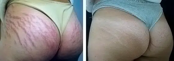 Stretch Marks treatment results