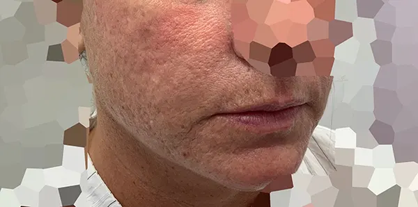 Close-up of a man's face showing skin texture and scars before Fraxel Laser treatment