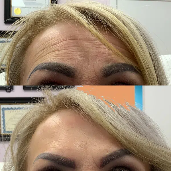 botox for forehead