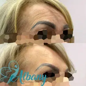 botox injections results