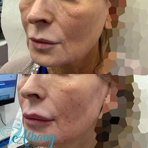 facelift results