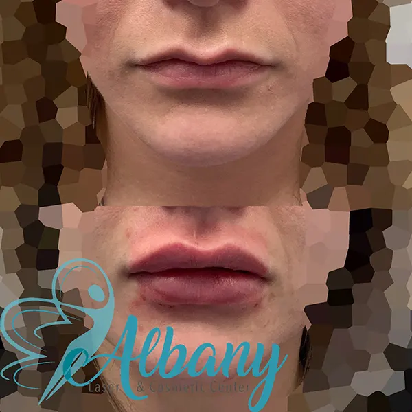 Juvederm lip fillers results