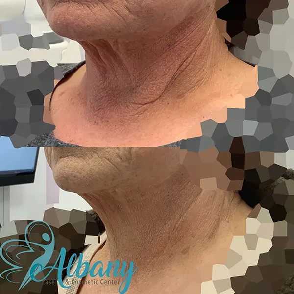 before and after neck lift in Edmotnon