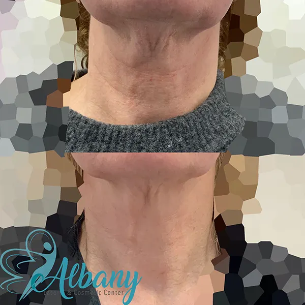 Laser neck tightening