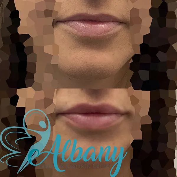 lip fillers Edmonton