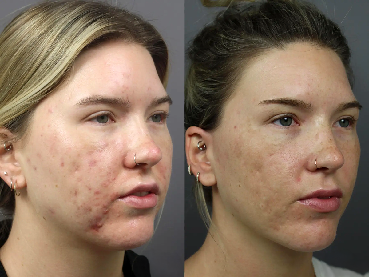 Front view of a female patient before and after scar treatment. Skin appears smoother with reduced acne marks