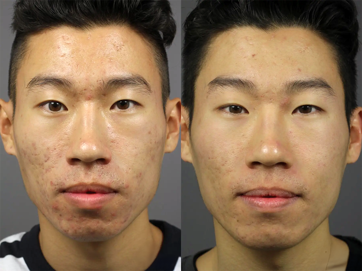 Before and after results of treatment on a male patient. Significant improvement in skin clarity and texture.