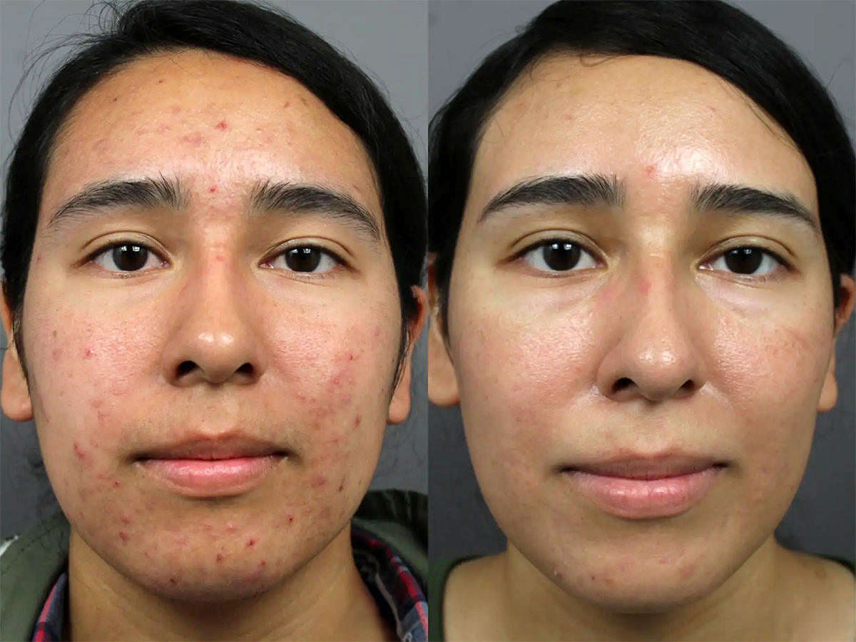 Before and after results of treatment on a male patient. Significant improvement in skin clarity and texture.