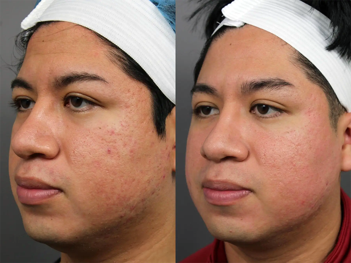 Side view of a female patient before and after acne scar treatment. Reduced inflammation and smoother complexion