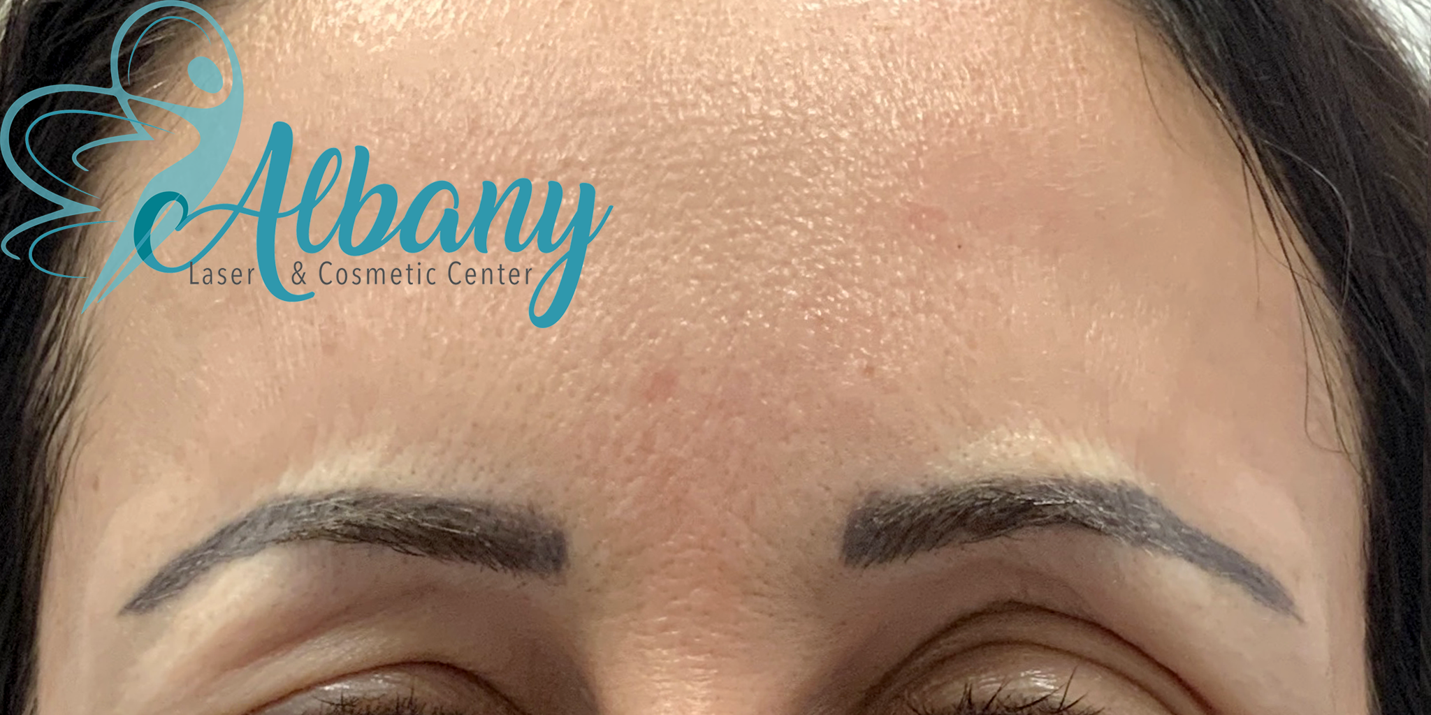 After picture of a patient's forehead demonstrating a significant reduction in frown lines and wrinkles following treatment at Albany Cosmetic and Laser Centre in Edmonton