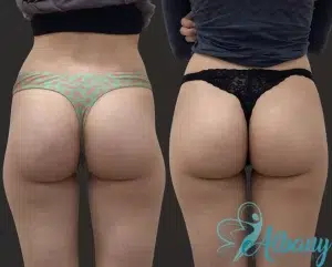 Before and after Brazilian Butt Lift results showing improved buttock shape in a woman