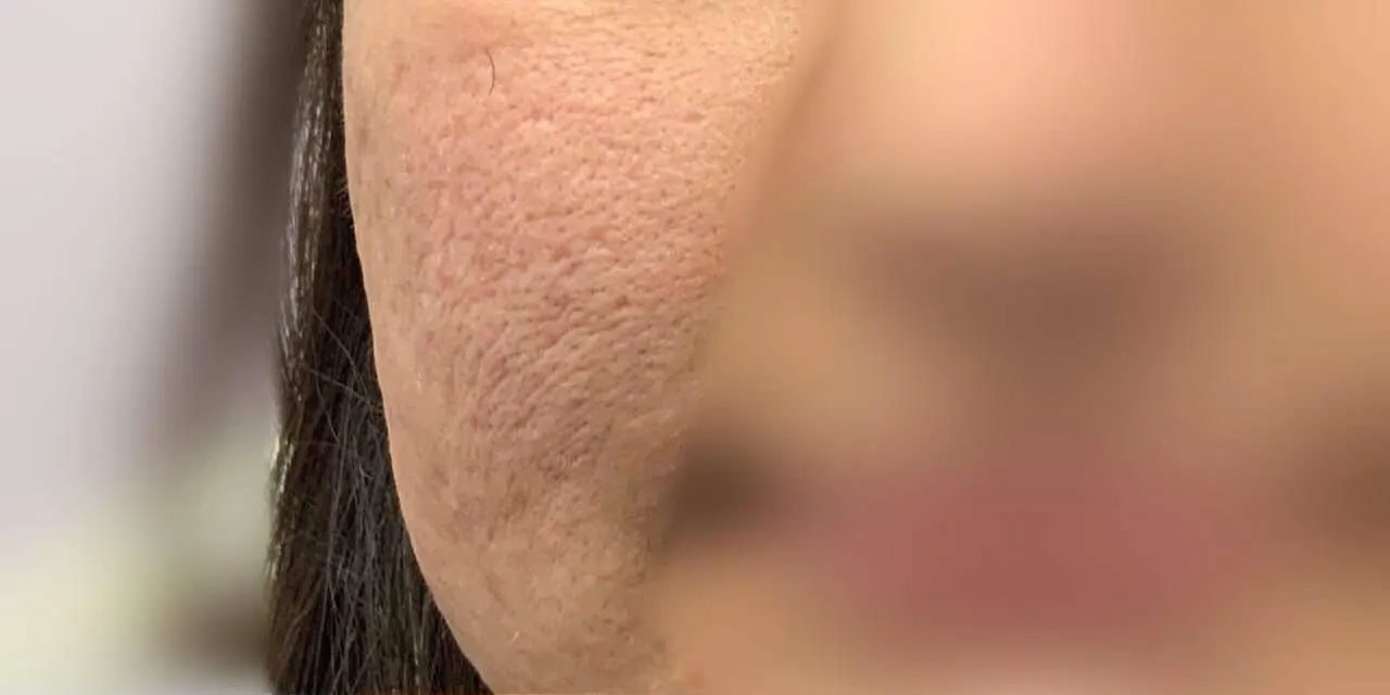 Before Enlarged pores treatment