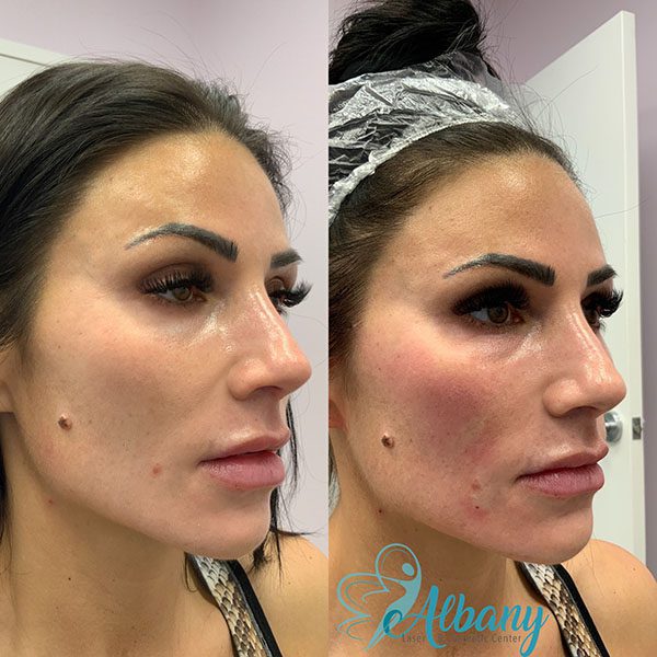Before and after fillers