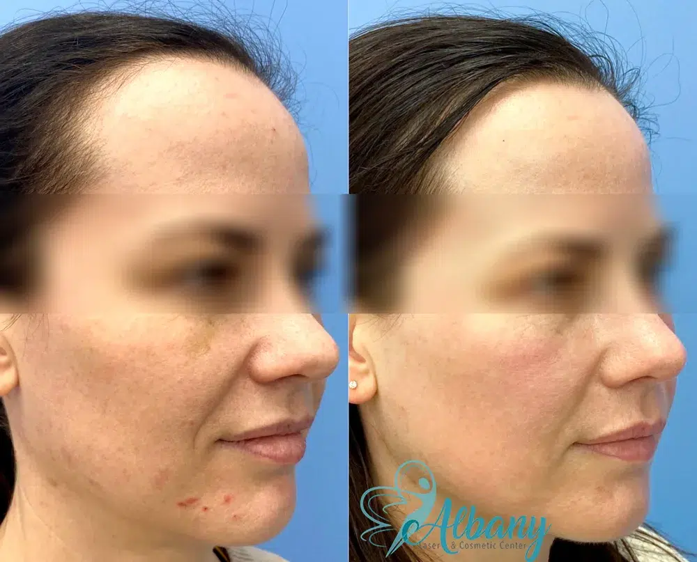 Before and after Fotona Laser skin resurfacing