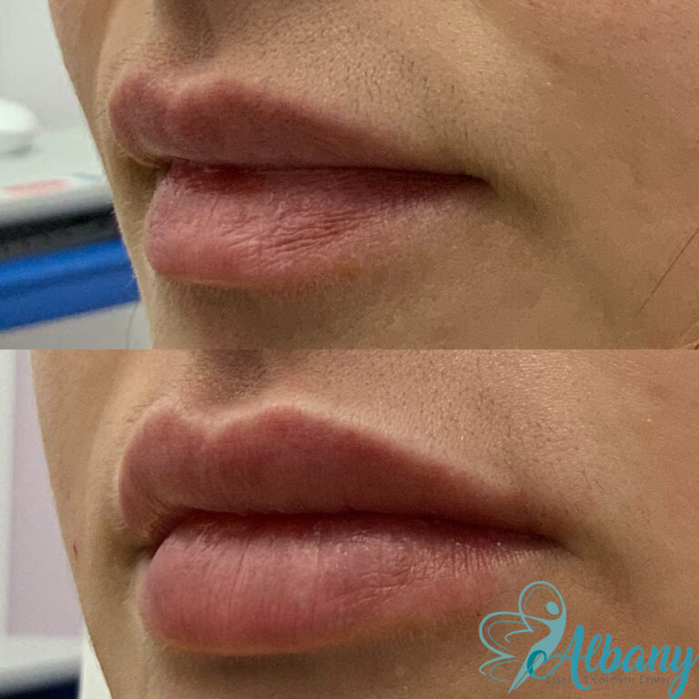 Before and after Lip fillers