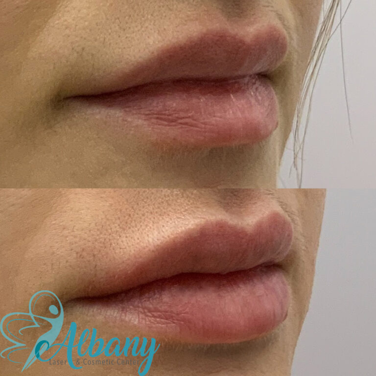 Before and after Lip fillers