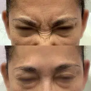 Before-and-after photo of Botox treatment on the forehead, showing reduction of horizontal wrinkles and smoother skin texture.
