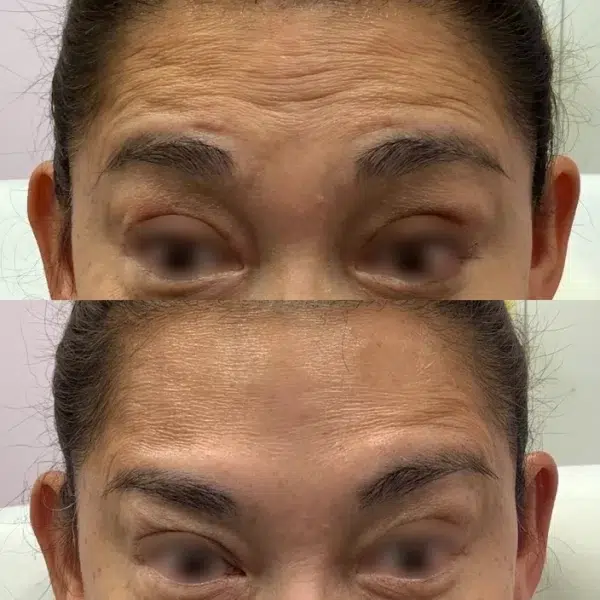 Before-and-after photo of Botox treatment on the forehead, showing reduced wrinkles and smoother skin.