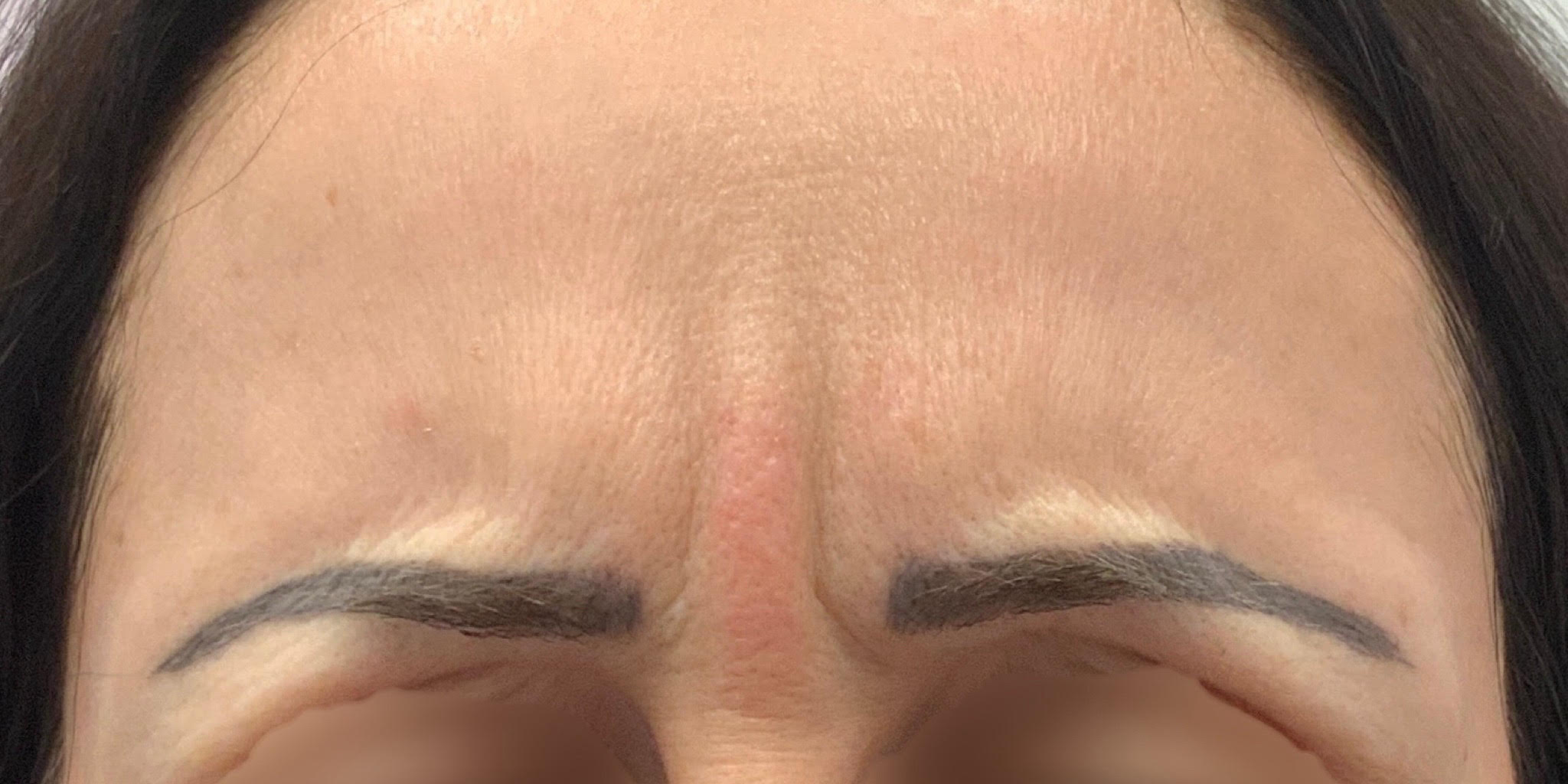 Before pictures of a patient's forehead demonstrating a significant reduction in frown lines and wrinkles following treatment at Albany Cosmetic and Laser Centre in Edmonton