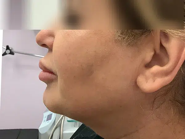 Before jawline filler injections
