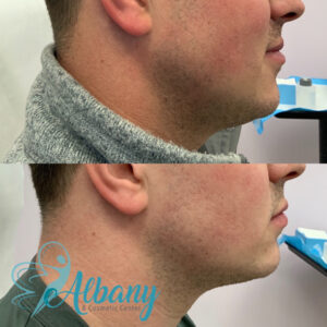 belkyra double chin reduction results