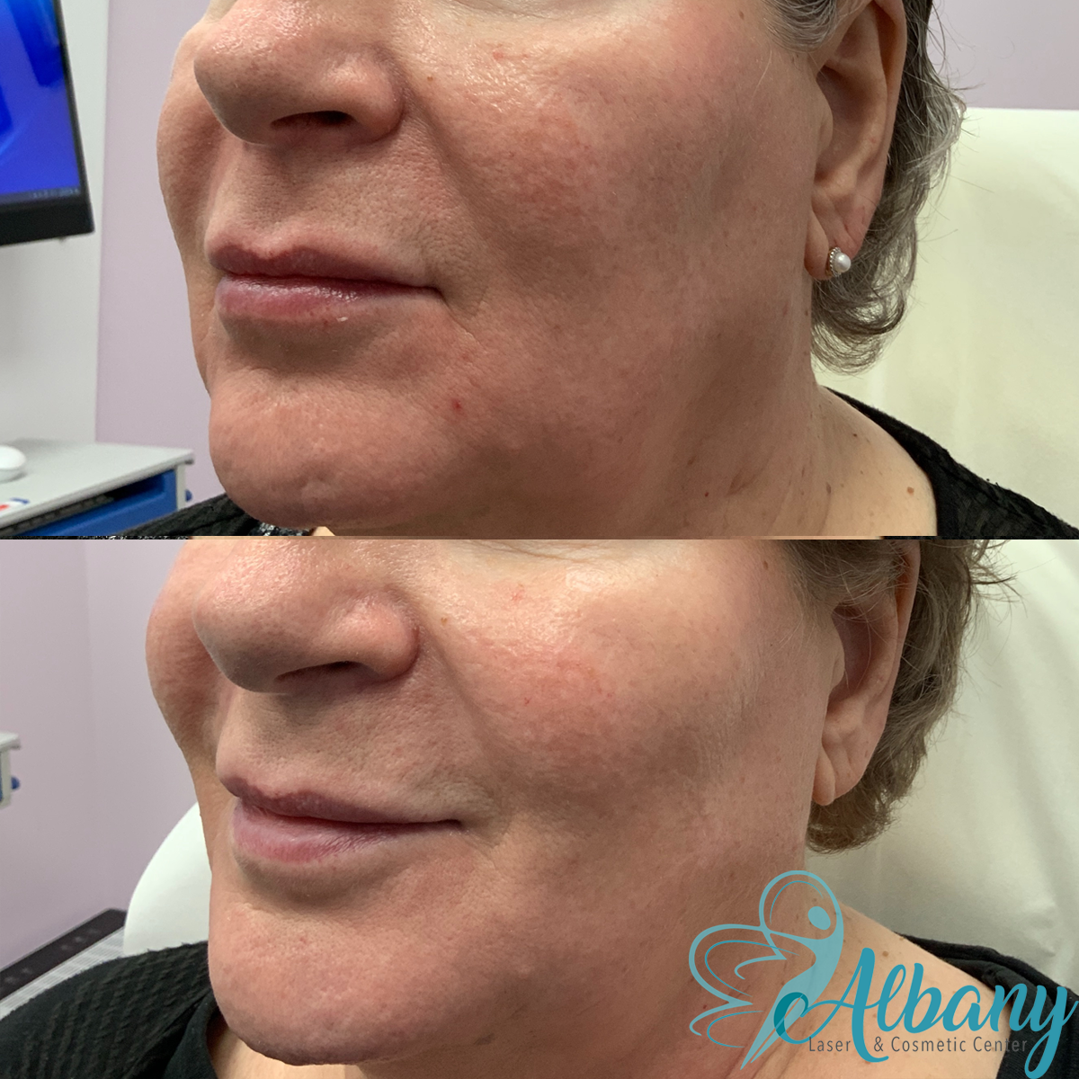 Before and after image of a woman's face showing the left side, highlighting improvements in skin texture and reduction in wrinkles after Bellafill fillers treatment at Albany Laser & Cosmetic Center