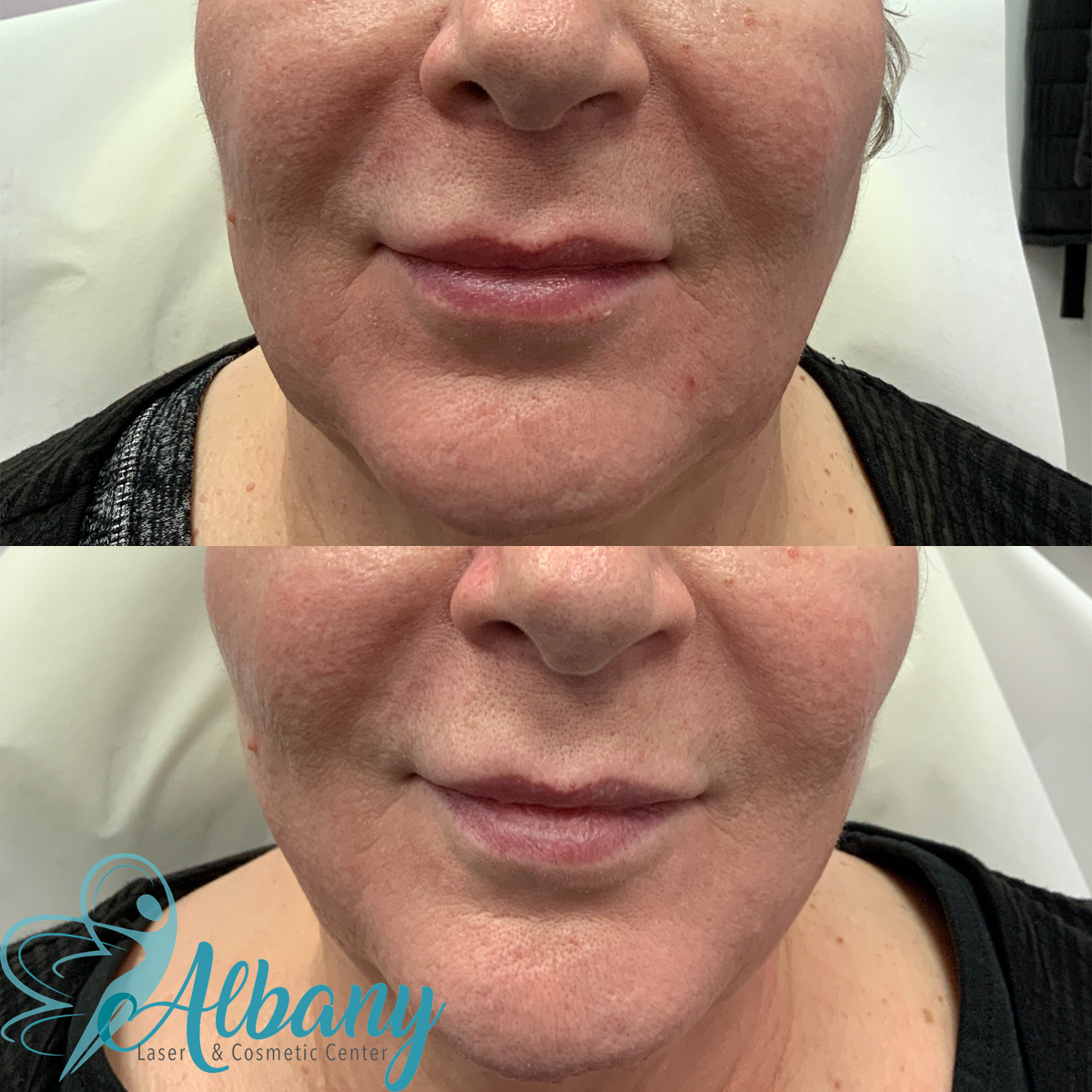 Before and after image of a woman's face showing a front view, illustrating smoother skin and diminished lines around the mouth following Bellafill fillers procedure at Albany Laser & Cosmetic Center.