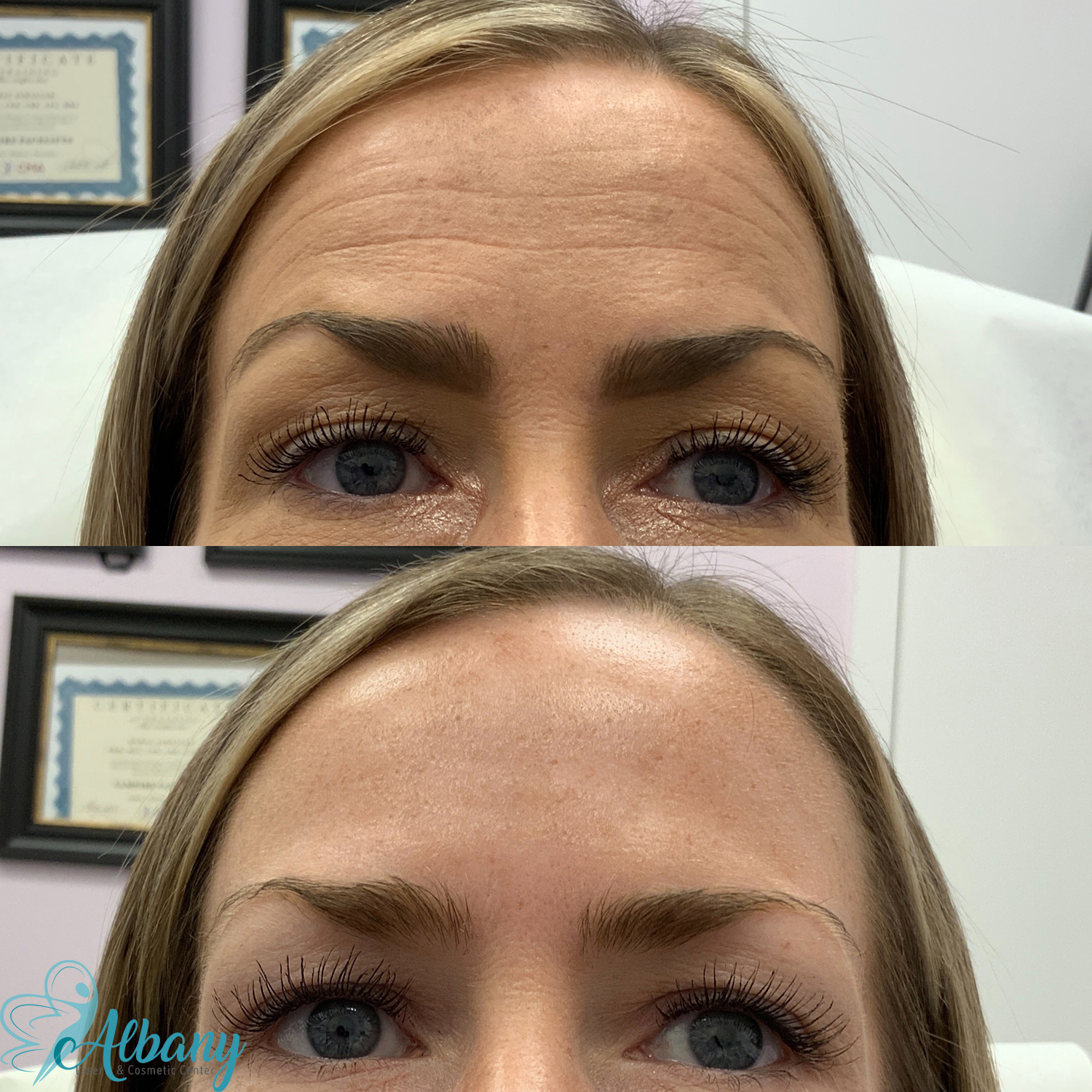 Results Botox Treatment for forehead lines