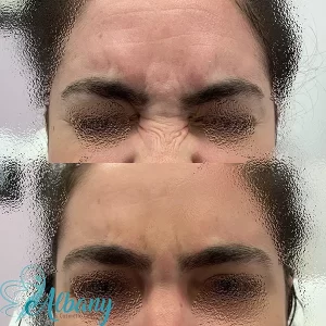 Before and after Frown lines correction with botox