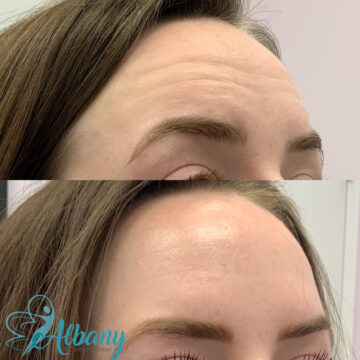 Side profile of a woman's forehead before and after Botox treatment, highlighting smoother skin and diminished wrinkles.