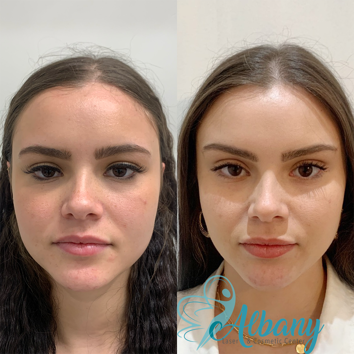 picture showing before and after cat Brow lift