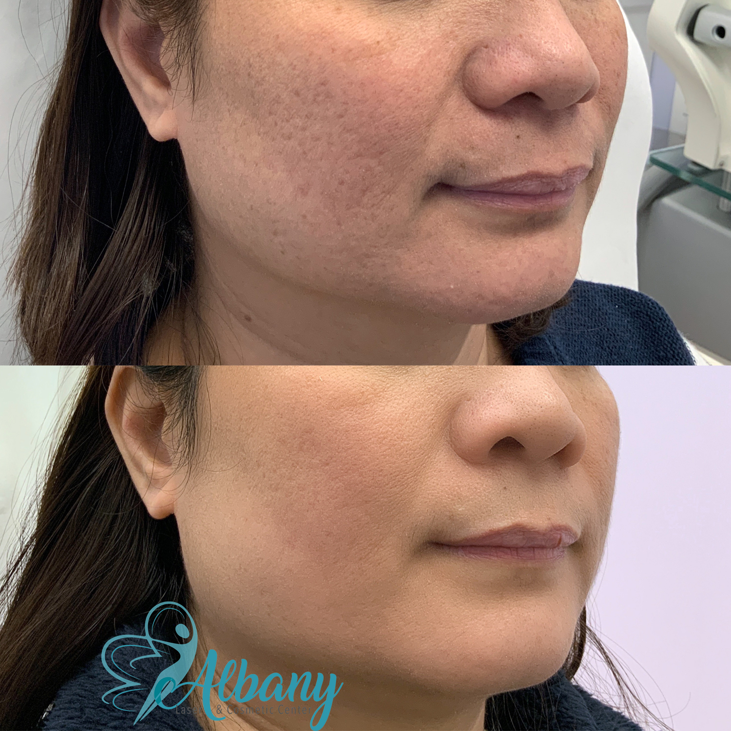 Before and after CO2 Laser Edmonton