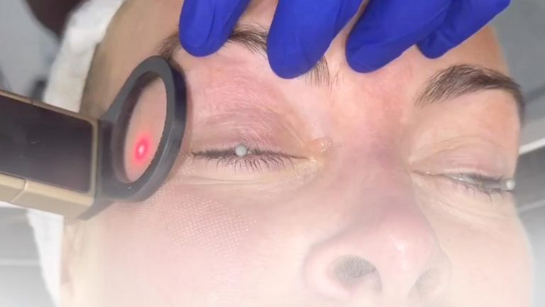 CO2 laser skin resurfacing at Albany Cosmetic and Laser Centre in Edmonton-Thumbnail