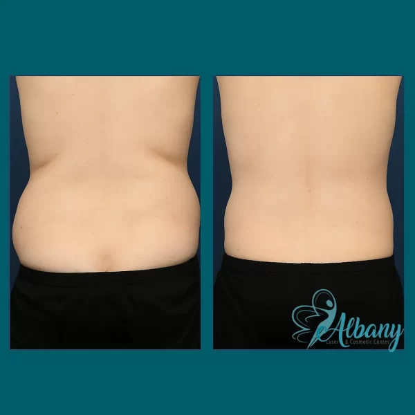 Before-and-after CoolSculpting results for love handles on a woman's lower back. The left image shows a wider waistline with visible fat accumulation, while the right image demonstrates a more contoured waist with smoother skin and reduced fat deposits.