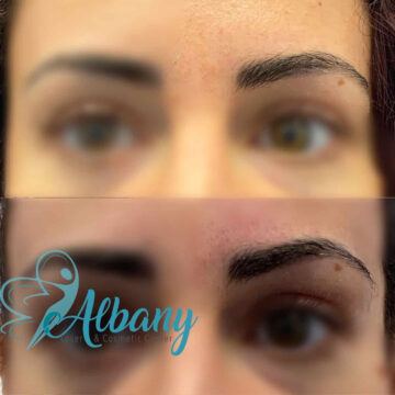 before and after eyebrow lift