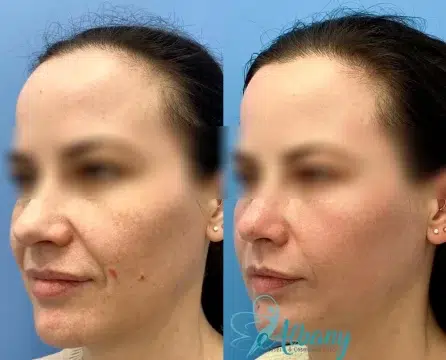 beforeand Fotona laser facelift
